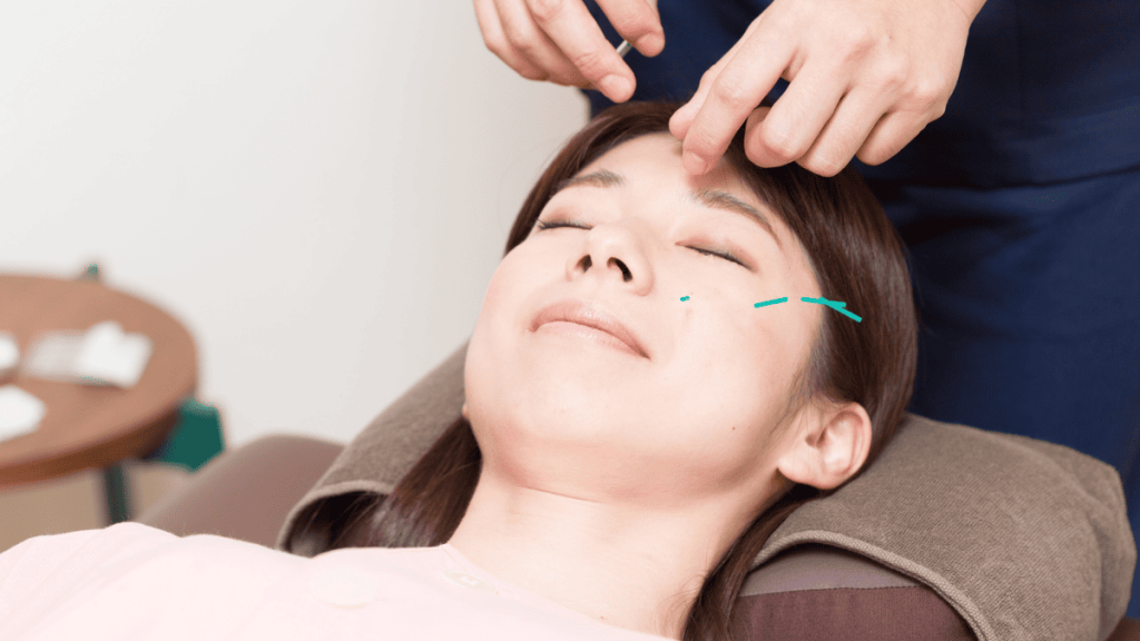 美容鍼治療を受ける女性