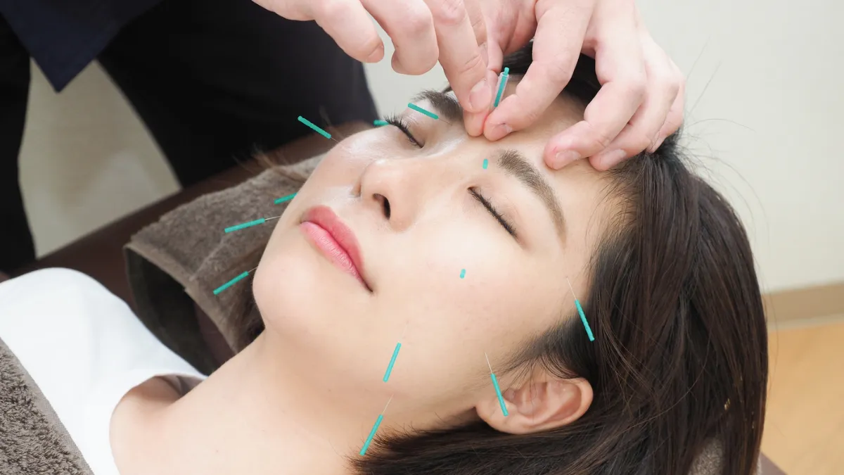 女性患者の顔に美容鍼を施術している様子